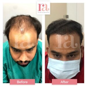 hair fall solutions