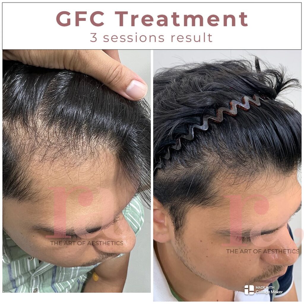 GFC Hair Treatment Before and After