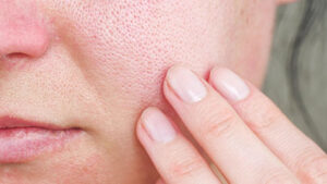 Open Pores Treatment in Pitampura, Delhi