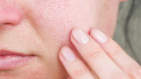 Open Pores Treatment in Pitampura, Delhi