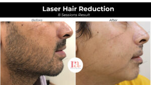 Laser Hair Removal in Pitampura, Delhi - Rakshaa Aesthetics