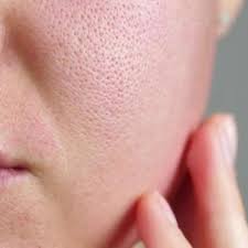 Acne and Scars Treatment in Pitampura