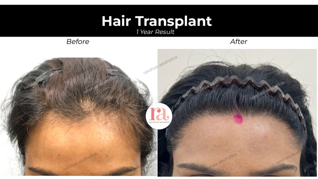 Hair Transplant Near Me 