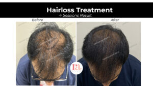 Hair Loss Treatment Near Me