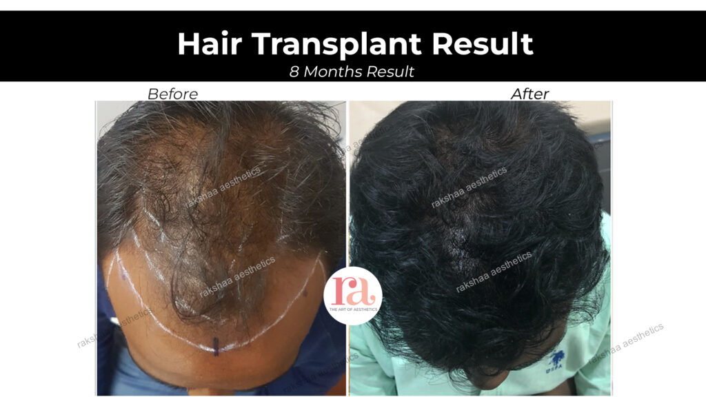 Hair Transplant Before & After Results