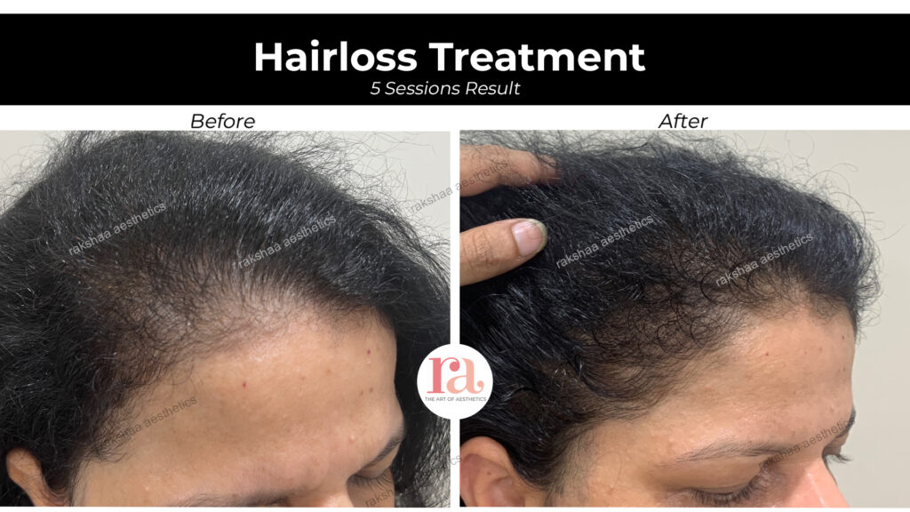 FUE Hair Transplant in Pitampura