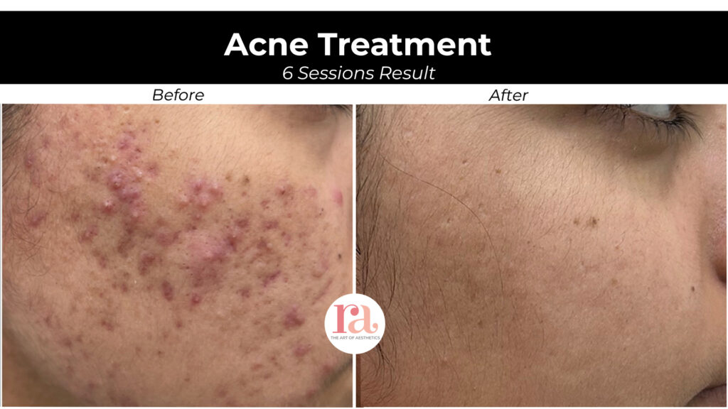 Pimples Treatment Near Me - Before & After Result