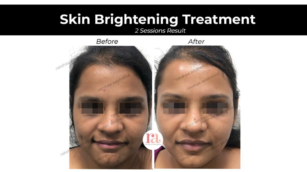 Skin Brightening Treatment in Punjabi Bagh - Before After Result