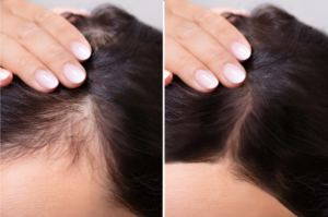 Best Hair Loss Treatments