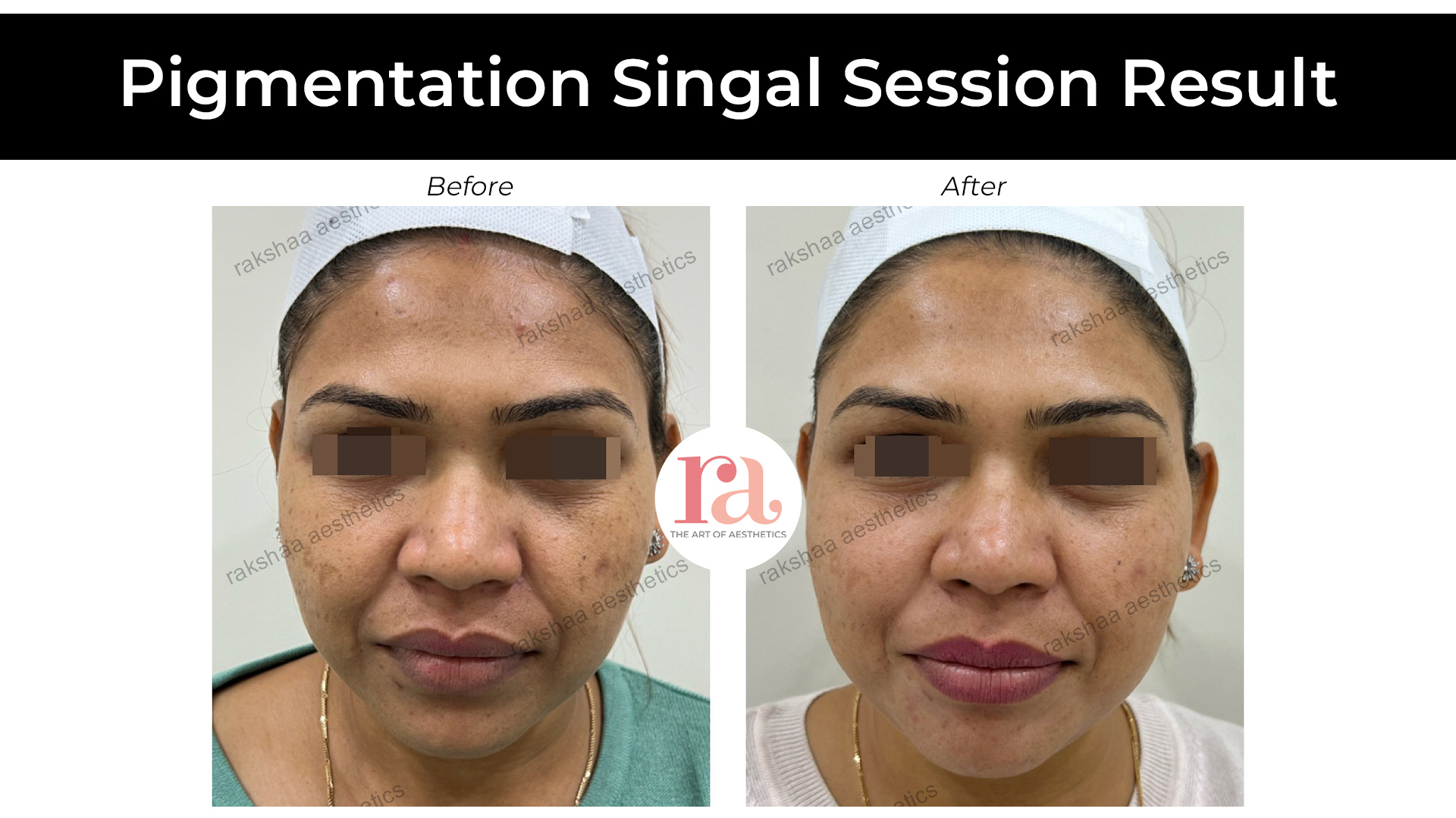 Skin Pigmentation