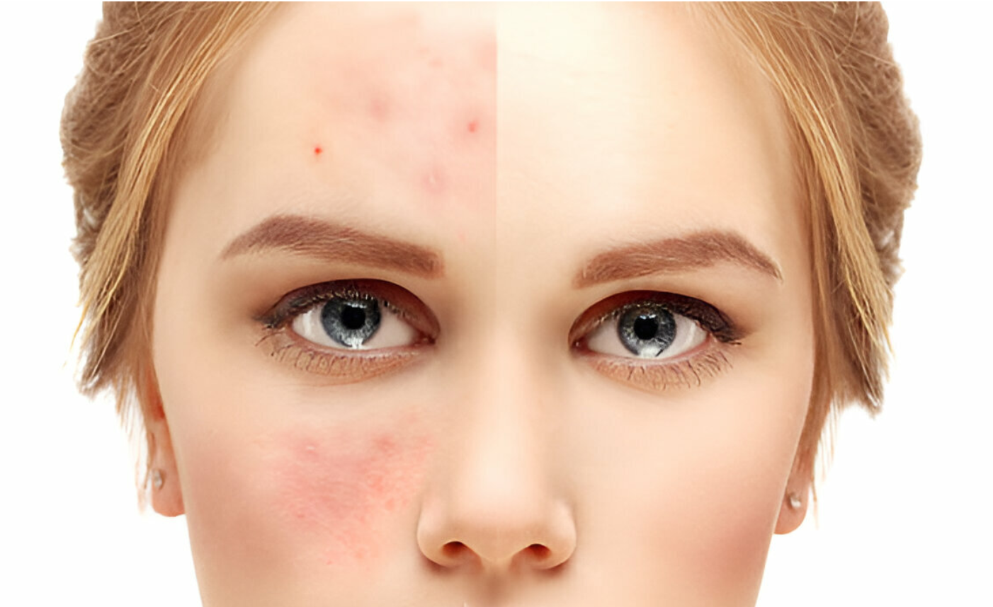 Acne Scar Treatment in Pitampura