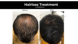 Hair Loss Treatment