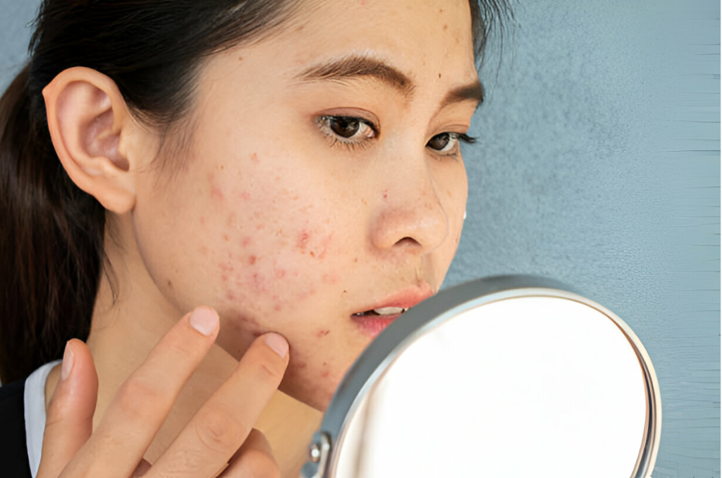 Pimple Treatments