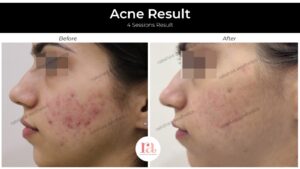 Acne Scar