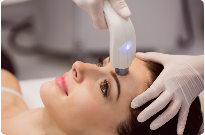 laser resurfacing