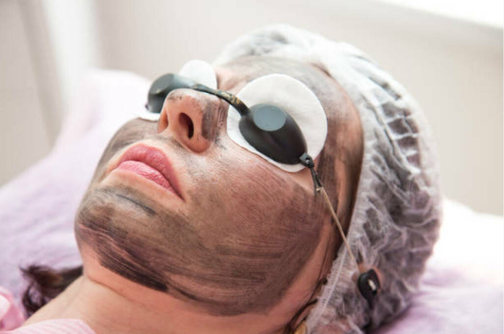 Carbon Laser Facial 