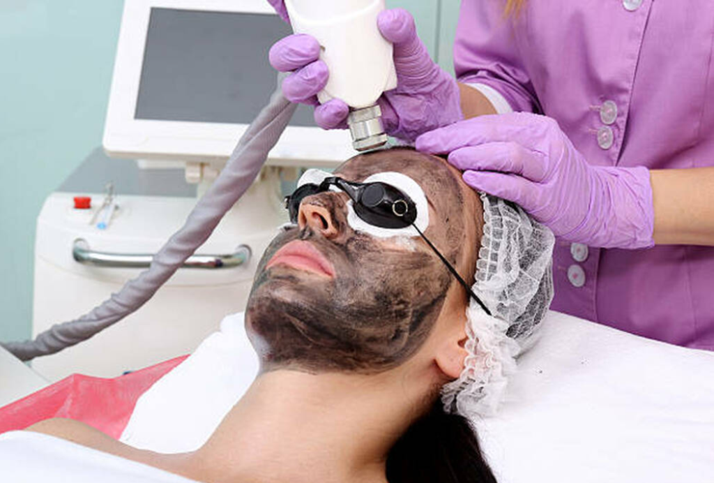 Carbon Laser Facial