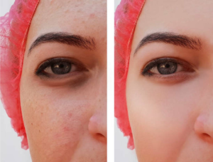 Pigmentation Treatments