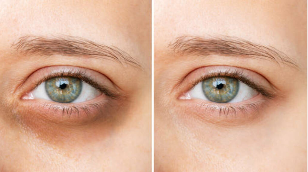 Dark Circles vs Under Eye Hollowness