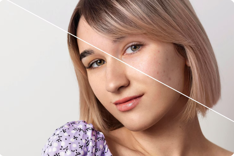 Pigmentation treatment in Delhi