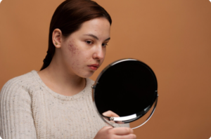 Pigmentation Treatment in Delhi