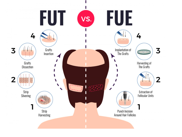 FUE Hair Transplant in Delhi
