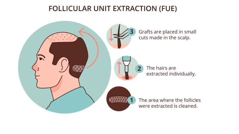 FUE Hair Transplant in Delhi