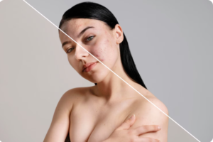 Top Dermatologist for Melasma Treatment in Pitampura