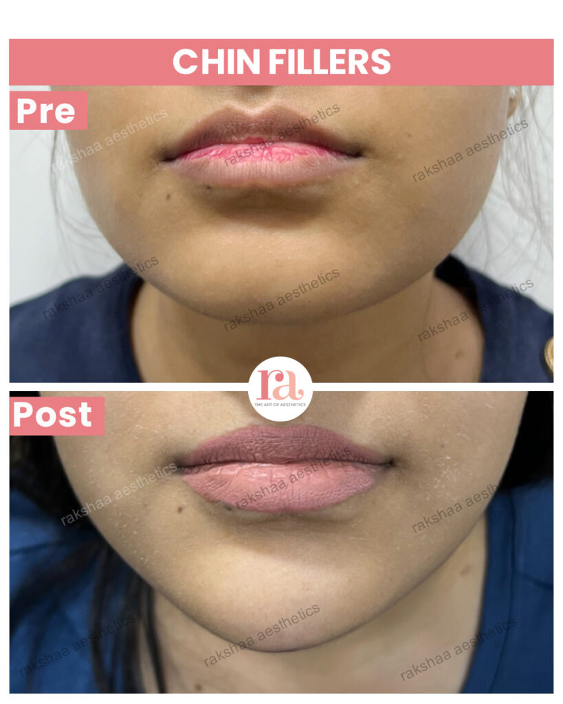 Double Chin Reduction Treatment in Delhi