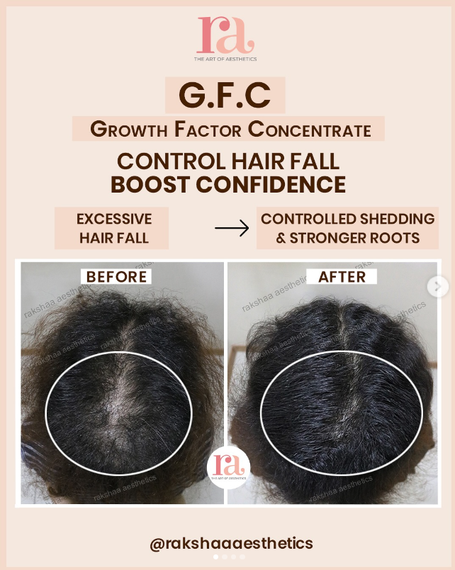 GFC Hair Treatment in Delhi