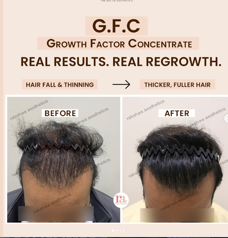 GFC Hair Treatment in Delhi