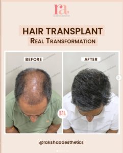 Hair Fall Solutions in Delhi