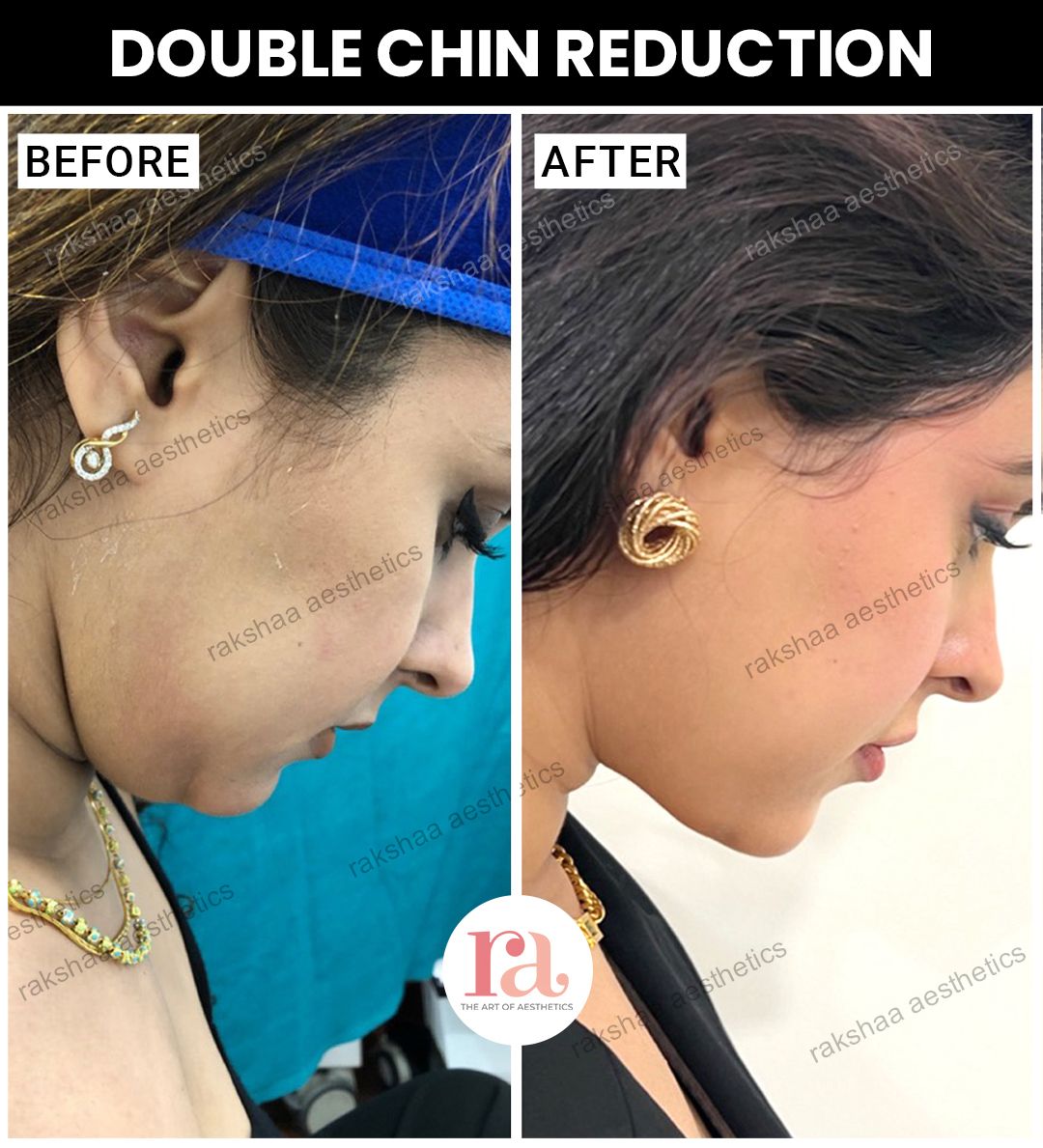 Double Chin Reduction Treatment in Delhi