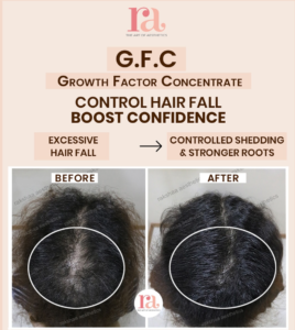 GFC Hair Treatment Delhi