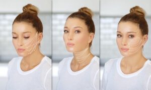 Thread Lift Treatment in Delhi