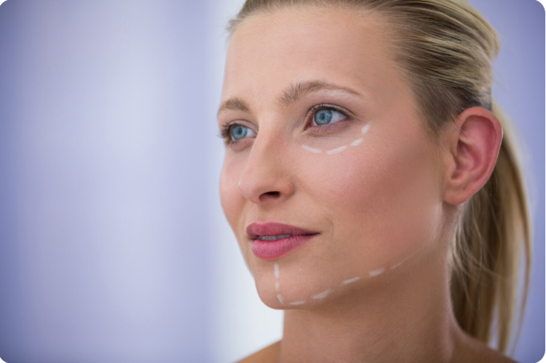 Thread Lift Treatment in Delhi