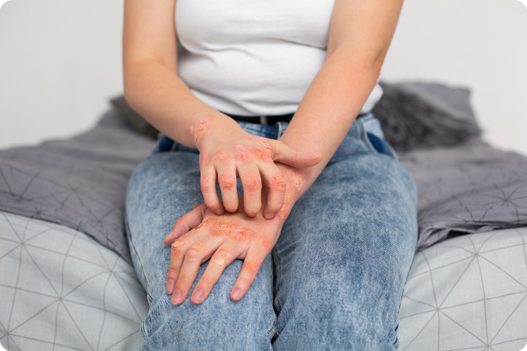 Eczema Treatment in Delhi