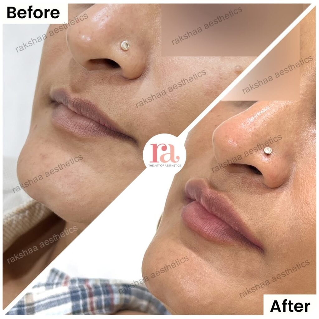 Lip Fillers treatment in Delhi