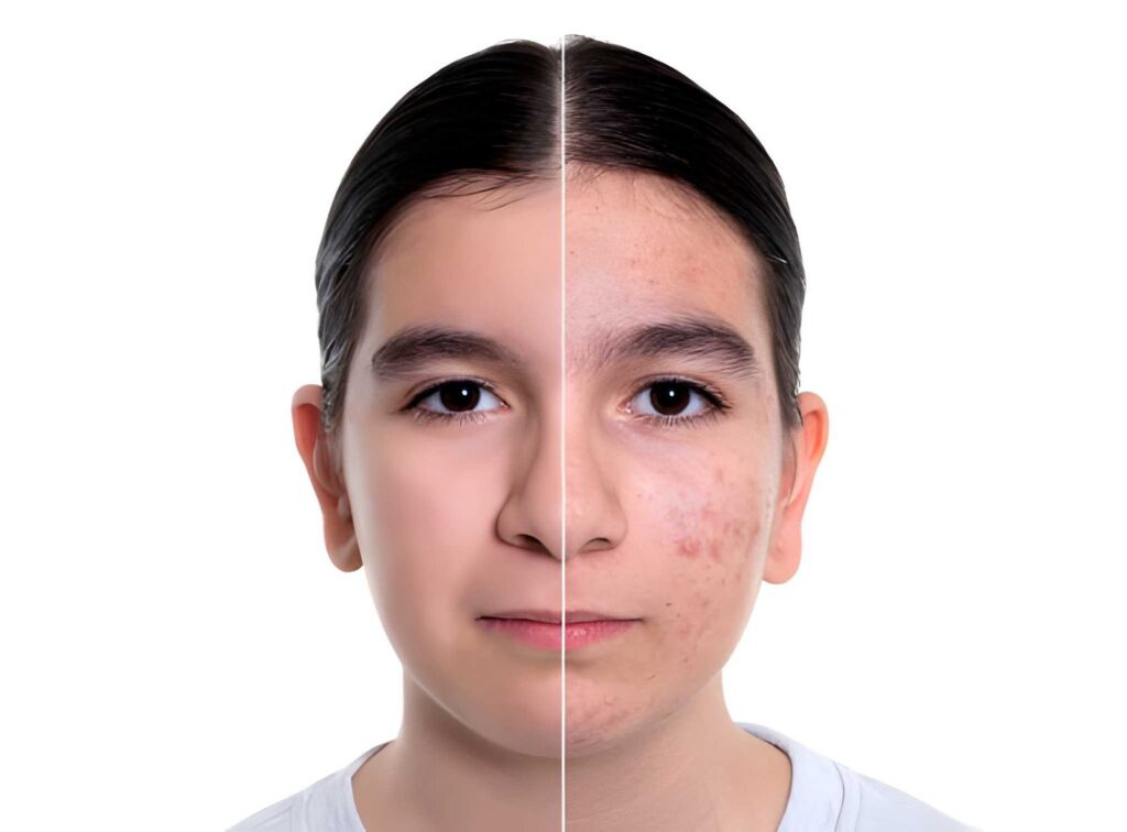 Acne Treatment in Pitampura, Delhi