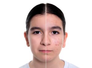 Acne Treatment in Pitampura, Delhi