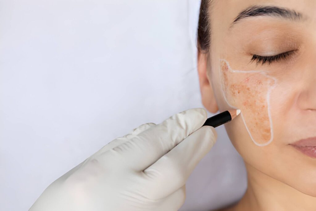Skin pigmentation treatment in Pitampura
