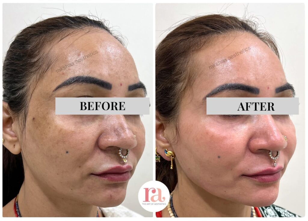 pigmentation treatment in Pitampura