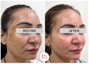 pigmentation treatment in Pitampura