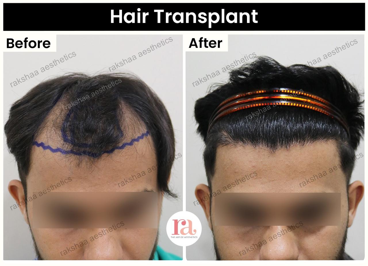 Hair Loss in Delhi