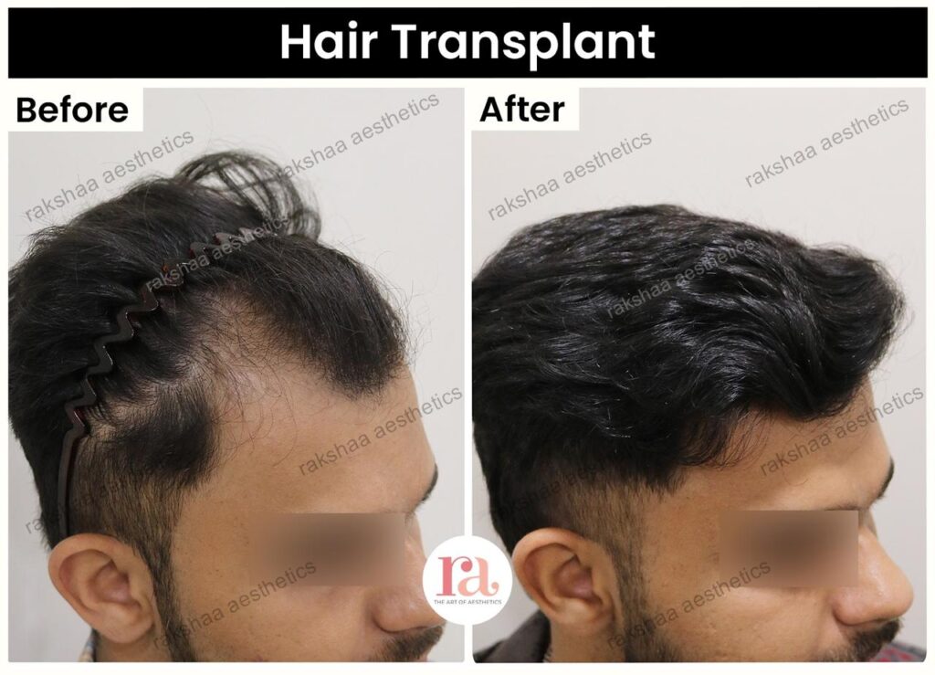 FUE Hair Transplant