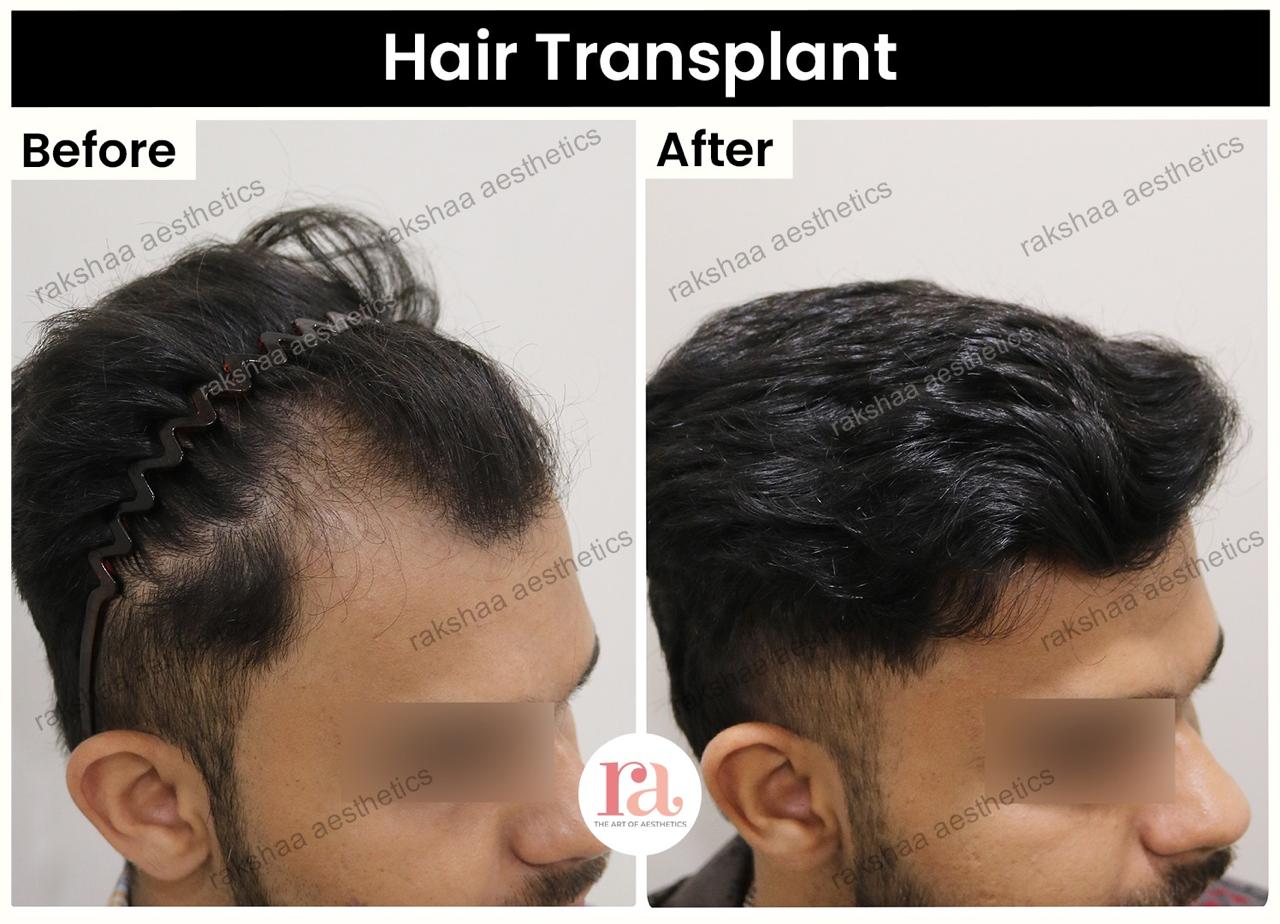 FUE Hair Transplant